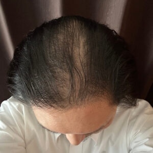 薄毛改善の検証実験開始より1年経過後　頭頂部状態　画像
